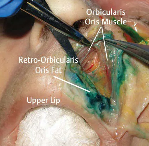 Fig 21. Cadaveric dissection of a fat compartment stained with dye